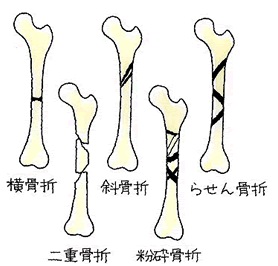 １５ 大腿骨骨幹部骨折 だいたいこつこつかんぶこっせつ 交通事故後遺症の法律相談は被害者側専門弁護士 東京渋谷法律事務所