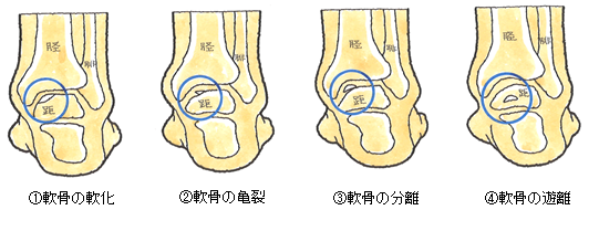 ６４ 足根骨の骨折 距骨骨軟骨損傷 きょこつこつなんこつそんしょう 交通事故後遺症の法律相談は被害者側専門弁護士 東京渋谷法律事務所