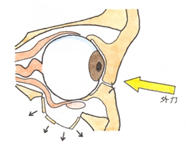 ５ 眼窩底骨折 がんかていこっせつ 交通事故後遺症の法律相談は被害者側専門弁護士 東京渋谷法律事務所