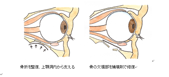 ５ 眼窩底骨折 がんかていこっせつ 交通事故後遺症の法律相談は被害者側専門弁護士 東京渋谷法律事務所